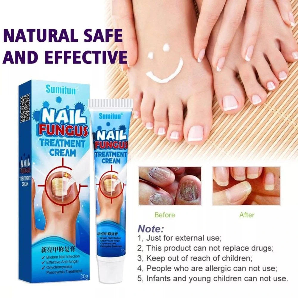 Pommade d'Ongle Sumifun لعلاج فطريات الأظافر والتهابات القدم