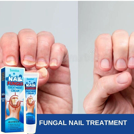 Pommade d'Ongle Sumifun لعلاج فطريات الأظافر والتهابات القدم