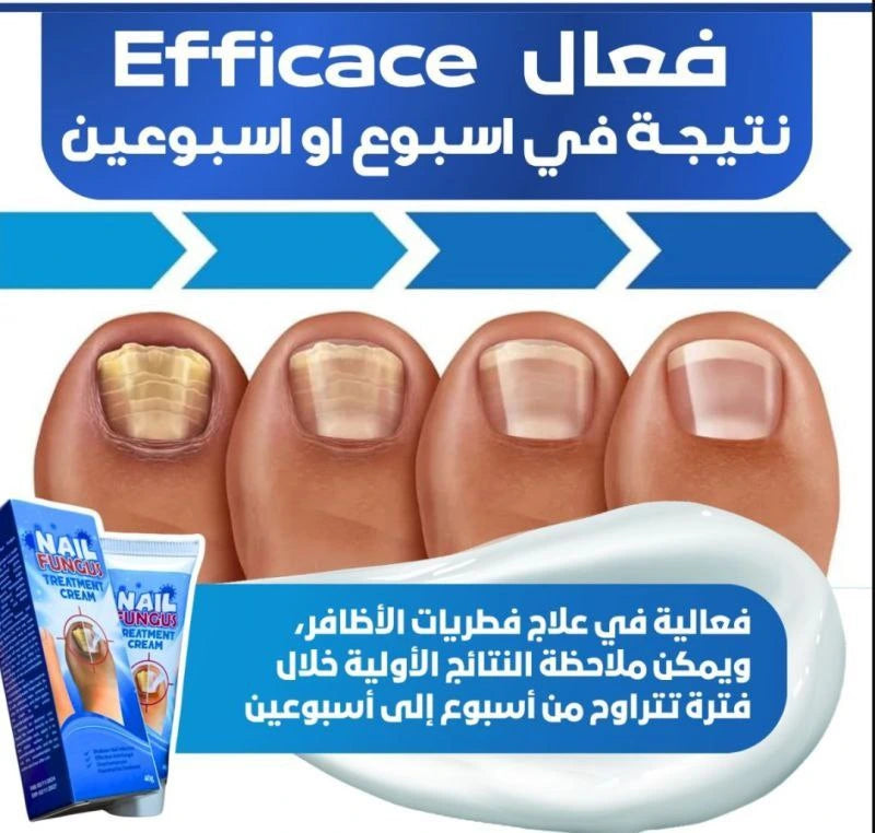 Pommade d'Ongle Sumifun لعلاج فطريات الأظافر والتهابات القدم