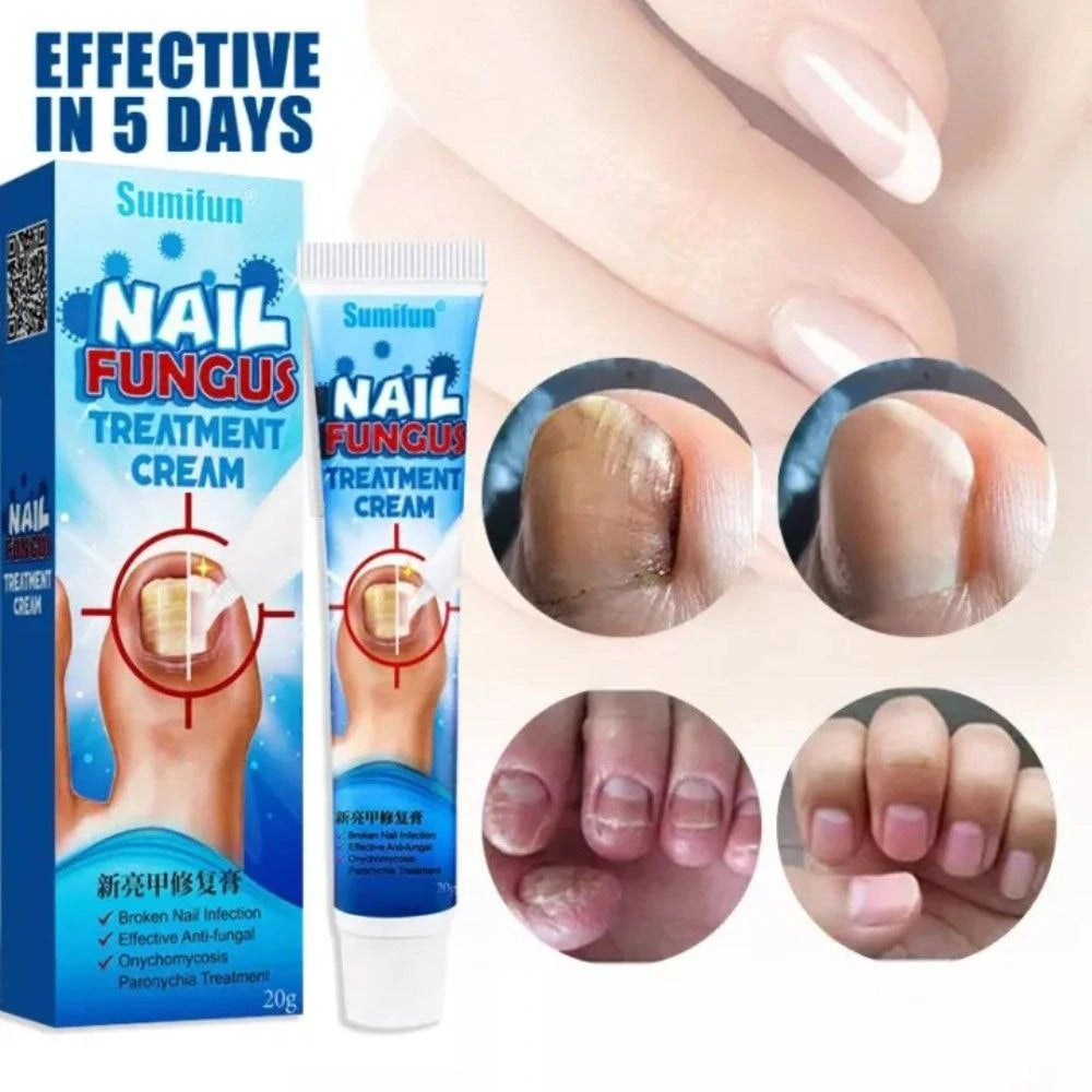 Pommade d'Ongle Sumifun لعلاج فطريات الأظافر والتهابات القدم
